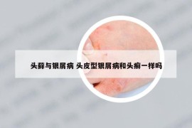 頭蘚與銀屑病 頭皮型銀屑病和頭癬一樣嗎
