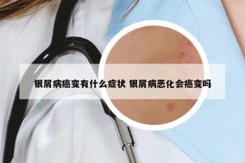 銀屑病癌變有什么癥狀 銀屑病惡化會癌變嗎