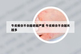 牛皮癬會不會越老越嚴(yán)重 牛皮癬會不會越長越多