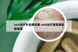 uvn治療牛皮癬效果 uvb治療銀屑病皮膚變黑
