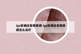 iga腎病還有銀屑病 iga腎病還有銀屑病怎么治療