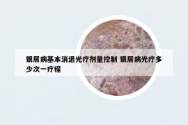 銀屑病基本消退光療劑量控制 銀屑病光療多少次一療程