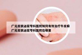 廣元皮膚泌尿?qū)？漆t(yī)院如何有效治療牛皮癬 廣元皮膚泌尿?qū)？漆t(yī)院在哪里