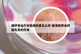 藏伊清治療皮膚病效果怎么樣 藏清膚草本抑菌乳膏的作用