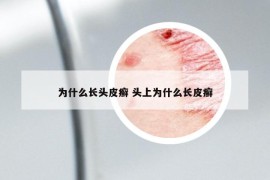 為什么長(zhǎng)頭皮癬 頭上為什么長(zhǎng)皮癬