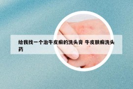 給我找一個(gè)治牛皮癬的洗頭膏 牛皮膚癬洗頭藥