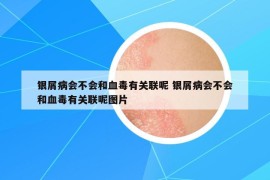 銀屑病會不會和血毒有關聯(lián)呢 銀屑病會不會和血毒有關聯(lián)呢圖片
