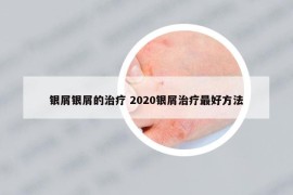 銀屑銀屑的治療 2020銀屑治療最好方法