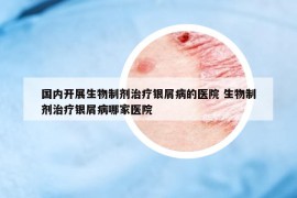 國內(nèi)開展生物制劑治療銀屑病的醫(yī)院 生物制劑治療銀屑病哪家醫(yī)院