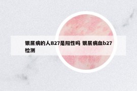 銀屑病的人B27是陽性嗎 銀屑病血b27檢測