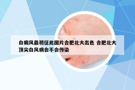 白癜風(fēng)最初征兆圖片合肥北大出色 合肥北大頂尖白風(fēng)病會(huì)不會(huì)傳染