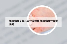 銀屑病打了好幾天針沒效果 銀屑病打針好得快嗎