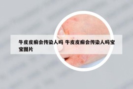 牛皮皮癬會(huì)傳染人嗎 牛皮皮癬會(huì)傳染人嗎寶寶圖片