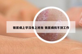 銀屑病上學(xué)沒有上班有 銀屑病找不到工作