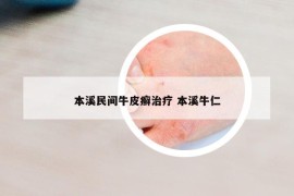 本溪民間牛皮癬治療 本溪牛仁