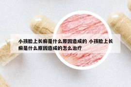 小孩臉上長癬是什么原因造成的 小孩臉上長癬是什么原因造成的怎么治療