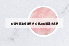 白礬和醋治療銀屑病 白礬加白醋涂抹皮膚