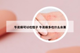 牛皮癬可以吃橙子 牛皮癬多吃什么水果