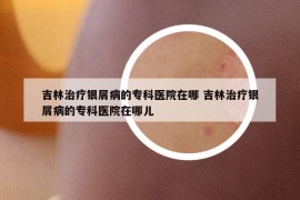 吉林治療銀屑病的?？漆t(yī)院在哪 吉林治療銀屑病的?？漆t(yī)院在哪兒