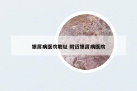 銀屑病醫(yī)院地址 附近銀屑病醫(yī)院