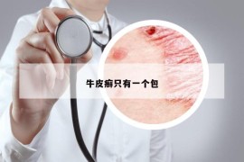 牛皮癬只有一個(gè)包