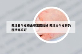 天津看牛皮癬去哪家醫(yī)院好 天津治牛皮鮮的醫(yī)院哪家好