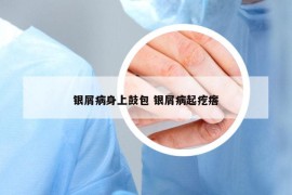 銀屑病身上鼓包 銀屑病起疙瘩