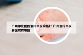 廣州哪些醫(yī)院治療牛皮癬最好 廣州治療牛皮鮮醫(yī)院有哪些