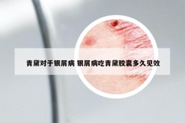 青黛對于銀屑病 銀屑病吃青黛膠囊多久見效
