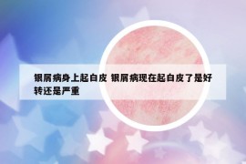 銀屑病身上起白皮 銀屑病現(xiàn)在起白皮了是好轉(zhuǎn)還是嚴(yán)重