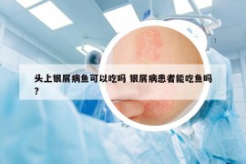 頭上銀屑病魚(yú)可以吃嗎 銀屑病患者能吃魚(yú)嗎?