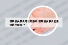銀屑病關節(jié)炎可以熱敷嗎 銀屑病關節(jié)炎能用熱水泡腳嗎??