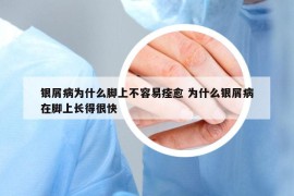 銀屑病為什么腳上不容易痊愈 為什么銀屑病在腳上長得很快