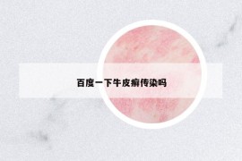 百度一下牛皮癬傳染嗎