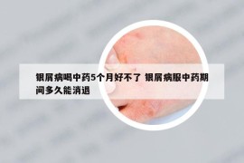 銀屑病喝中藥5個(gè)月好不了 銀屑病服中藥期間多久能消退