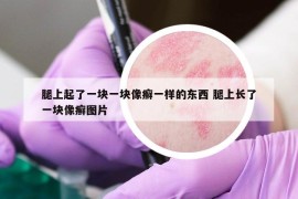 腿上起了一塊一塊像癬一樣的東西 腿上長了一塊像癬圖片