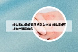 維生素D3治療銀屑病怎么吃法 維生素d可以治療銀屑病嗎