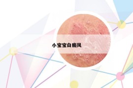 小寶寶白癜風(fēng)