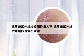 銀屑病紫外線治療副作用大不 銀屑病紫外線治療副作用大不大呀