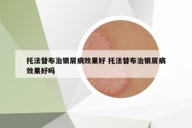 托法替布治銀屑病效果好 托法替布治銀屑病效果好嗎