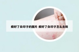 癬好了白印子的圖片 癬好了白印子怎么去除