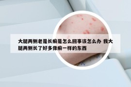 大腿兩側(cè)老是長癬是怎么回事該怎么辦 我大腿兩側(cè)長了好多像癬一樣的東西