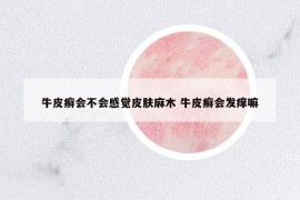 牛皮癬會(huì)不會(huì)感覺皮膚麻木 牛皮癬會(huì)發(fā)癢嘛