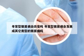 尋常型銀屑病會改變嗎 尋常型銀屑病會發(fā)展成其它類型的銀屑病嗎