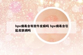hpv病毒會導(dǎo)致牛皮癬嗎 hpv病毒會引起皮膚病嗎