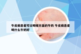 牛皮癬患者可以喝哪方面的牛奶 牛皮癬患者喝什么牛奶好