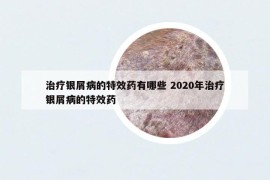 治療銀屑病的特效藥有哪些 2020年治療銀屑病的特效藥