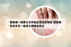 銀屑病一般第幾年開始出現(xiàn)關(guān)節(jié)病變 銀屑病性關(guān)節(jié)炎一般多久病情會惡化