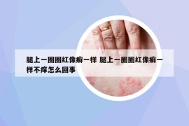 腿上一圈圈紅像癬一樣 腿上一圈圈紅像癬一樣不癢怎么回事
