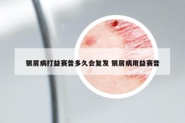 銀屑病打益賽普多久會(huì)復(fù)發(fā) 銀屑病用益賽普